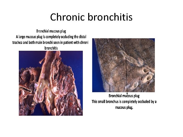 Chronic bronchitis 