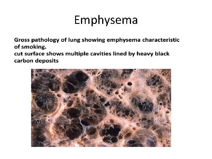 Emphysema 