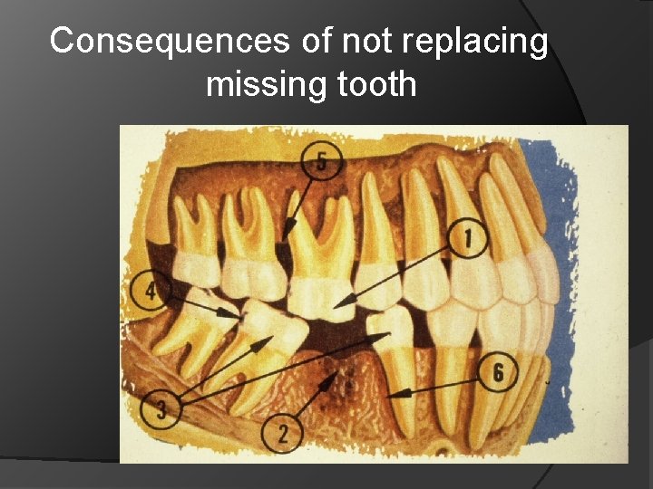 Consequences of not replacing missing tooth 