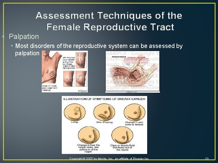 Assessment Techniques of the Female Reproductive Tract • Palpation • Most disorders of the