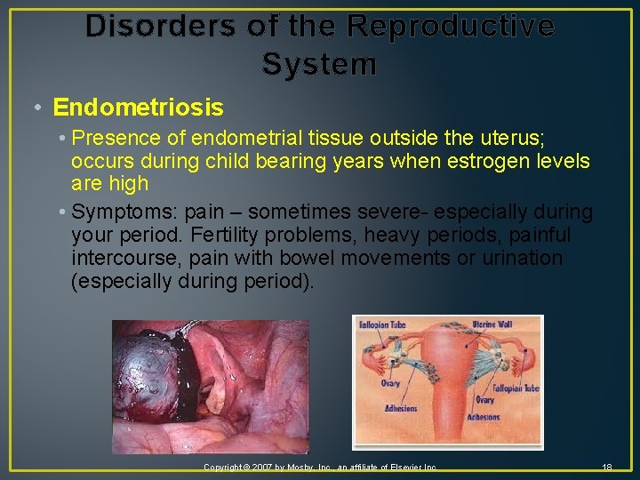 Disorders of the Reproductive System • Endometriosis • Presence of endometrial tissue outside the