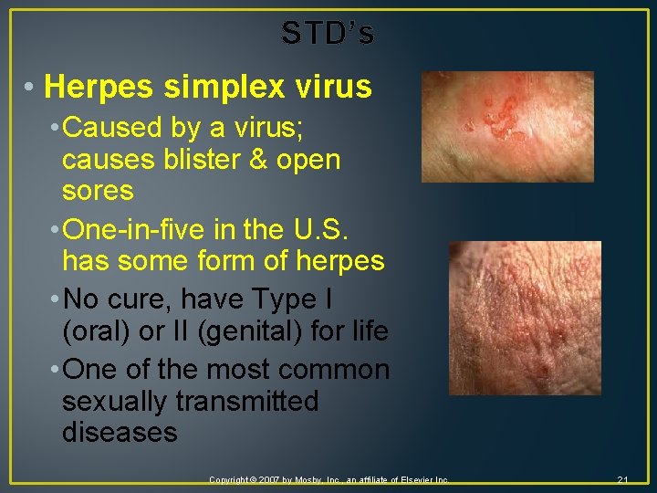 STD’s • Herpes simplex virus • Caused by a virus; causes blister & open