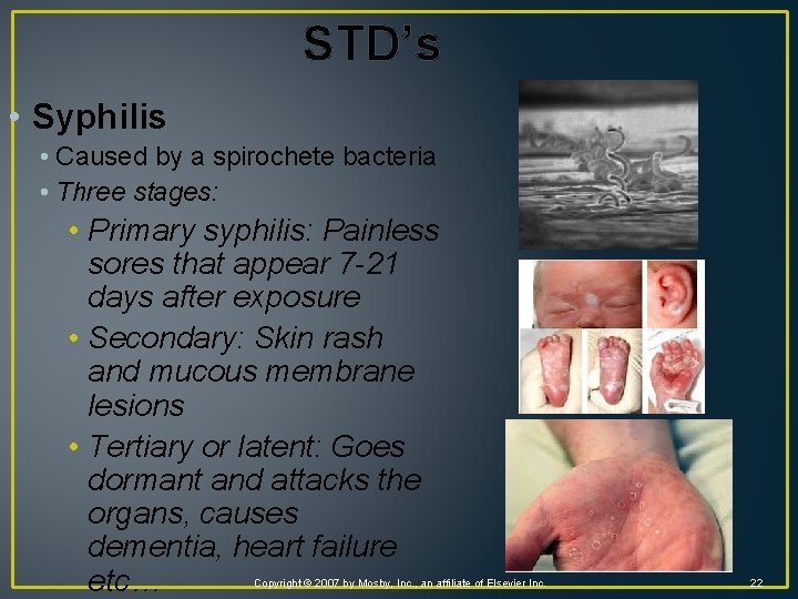 STD’s • Syphilis • Caused by a spirochete bacteria • Three stages: • Primary