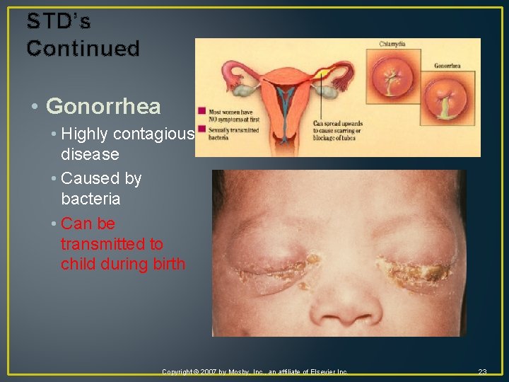 STD’s Continued • Gonorrhea • Highly contagious disease • Caused by bacteria • Can