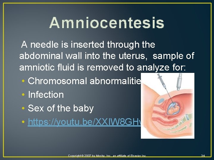 Amniocentesis A needle is inserted through the abdominal wall into the uterus, sample of