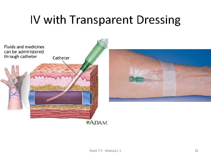 IV with Transparent Dressing Block 7. 0 Module 1. 1 31 