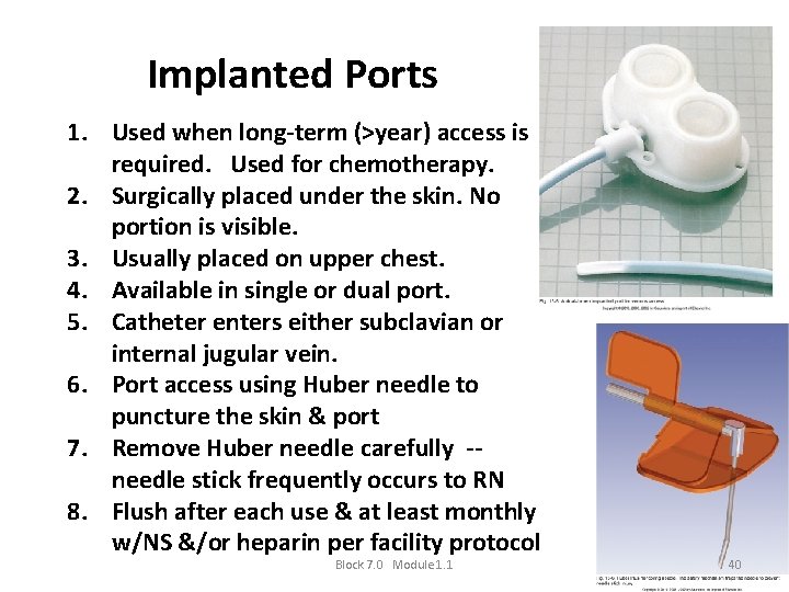 Implanted Ports 1. Used when long-term (>year) access is required. Used for chemotherapy. 2.