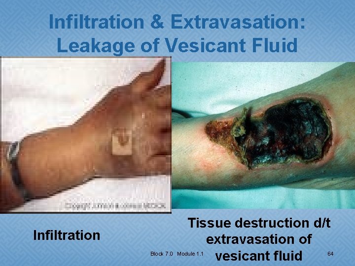 Infiltration & Extravasation: Leakage of Vesicant Fluid Infiltration Tissue destruction d/t extravasation of vesicant