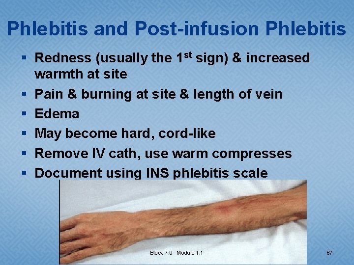 Phlebitis and Post-infusion Phlebitis § Redness (usually the 1 st sign) & increased warmth