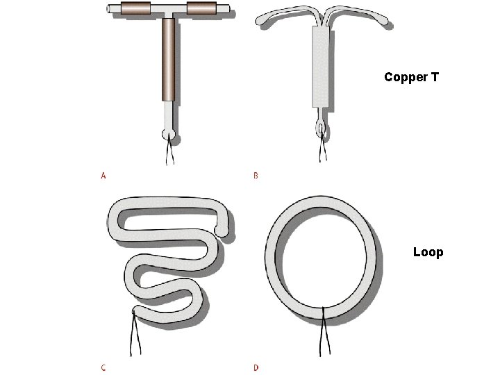 Copper T Loop 