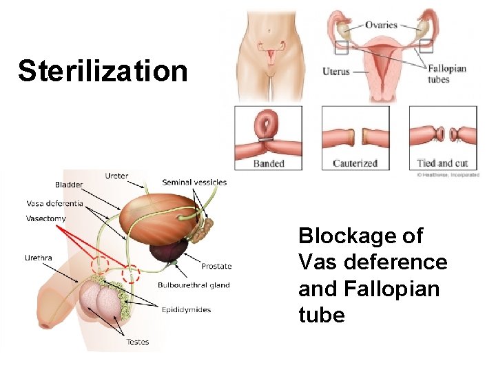 Sterilization Blockage of Vas deference and Fallopian tube 