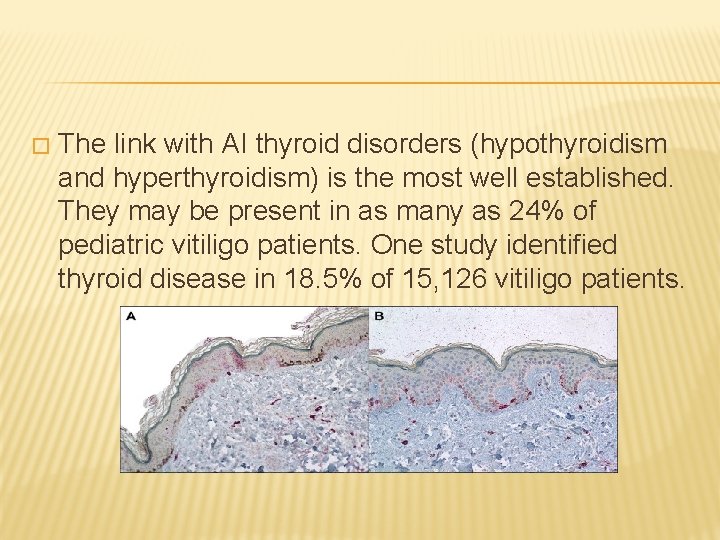 � The link with AI thyroid disorders (hypothyroidism and hyperthyroidism) is the most well