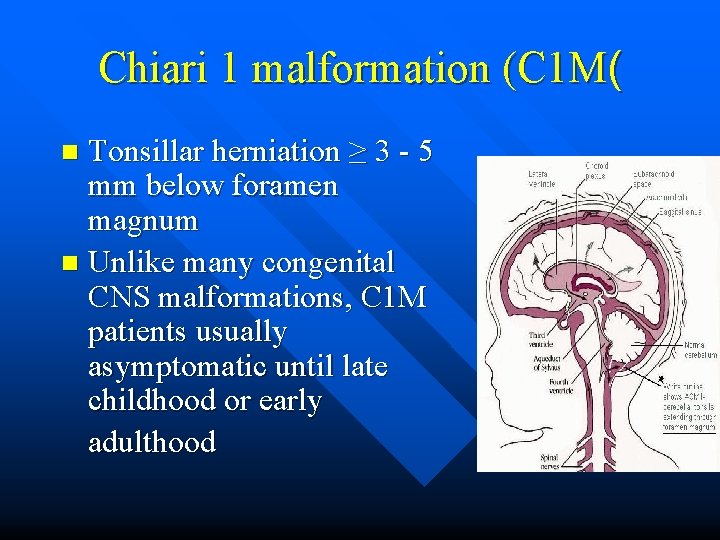 Chiari 1 malformation (C 1 M( Tonsillar herniation ≥ 3 - 5 mm below