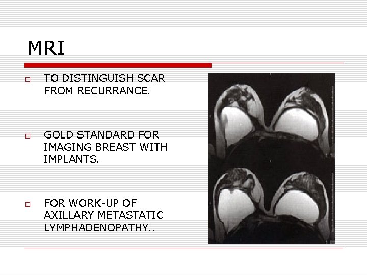 MRI o o o TO DISTINGUISH SCAR FROM RECURRANCE. GOLD STANDARD FOR IMAGING BREAST MRI o o o TO DISTINGUISH SCAR FROM RECURRANCE. GOLD STANDARD FOR IMAGING BREAST
