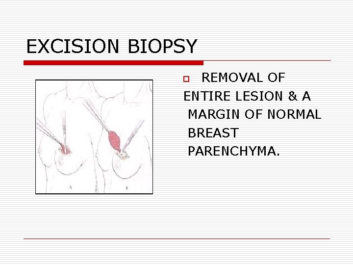 EXCISION BIOPSY REMOVAL OF ENTIRE LESION & A MARGIN OF NORMAL BREAST PARENCHYMA. o EXCISION BIOPSY REMOVAL OF ENTIRE LESION & A MARGIN OF NORMAL BREAST PARENCHYMA. o
