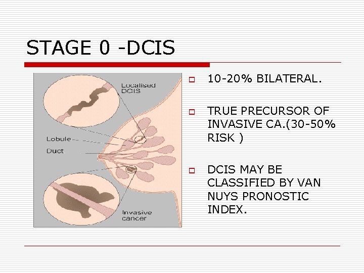 STAGE 0 -DCIS o o o 10 -20% BILATERAL. TRUE PRECURSOR OF INVASIVE CA. STAGE 0 -DCIS o o o 10 -20% BILATERAL. TRUE PRECURSOR OF INVASIVE CA.
