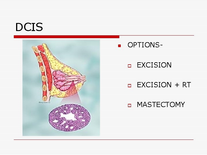 DCIS n OPTIONSo EXCISION + RT o MASTECTOMY DCIS n OPTIONSo EXCISION + RT o MASTECTOMY