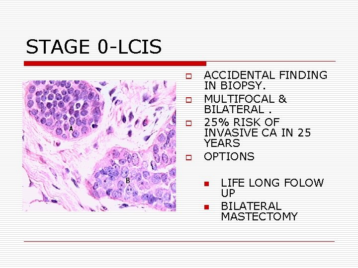 STAGE 0 -LCIS o o ACCIDENTAL FINDING IN BIOPSY. MULTIFOCAL & BILATERAL. 25% RISK STAGE 0 -LCIS o o ACCIDENTAL FINDING IN BIOPSY. MULTIFOCAL & BILATERAL. 25% RISK