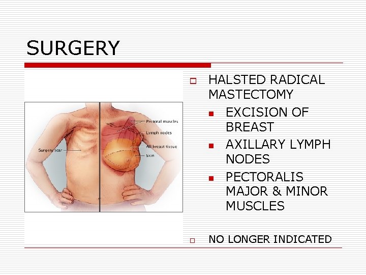SURGERY o o HALSTED RADICAL MASTECTOMY n EXCISION OF BREAST n AXILLARY LYMPH NODES SURGERY o o HALSTED RADICAL MASTECTOMY n EXCISION OF BREAST n AXILLARY LYMPH NODES