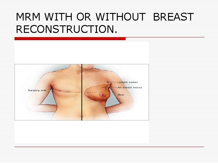 MRM WITH OR WITHOUT BREAST RECONSTRUCTION. MRM WITH OR WITHOUT BREAST RECONSTRUCTION.