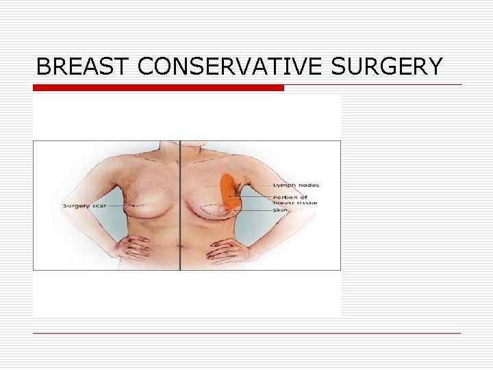 BREAST CONSERVATIVE SURGERY BREAST CONSERVATIVE SURGERY