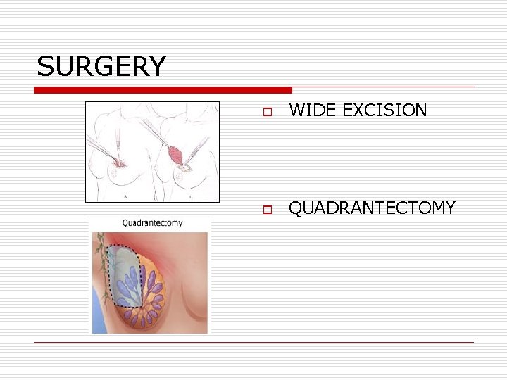 SURGERY o WIDE EXCISION o QUADRANTECTOMY SURGERY o WIDE EXCISION o QUADRANTECTOMY
