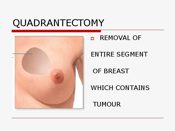 QUADRANTECTOMY o REMOVAL OF ENTIRE SEGMENT OF BREAST WHICH CONTAINS TUMOUR QUADRANTECTOMY o REMOVAL OF ENTIRE SEGMENT OF BREAST WHICH CONTAINS TUMOUR