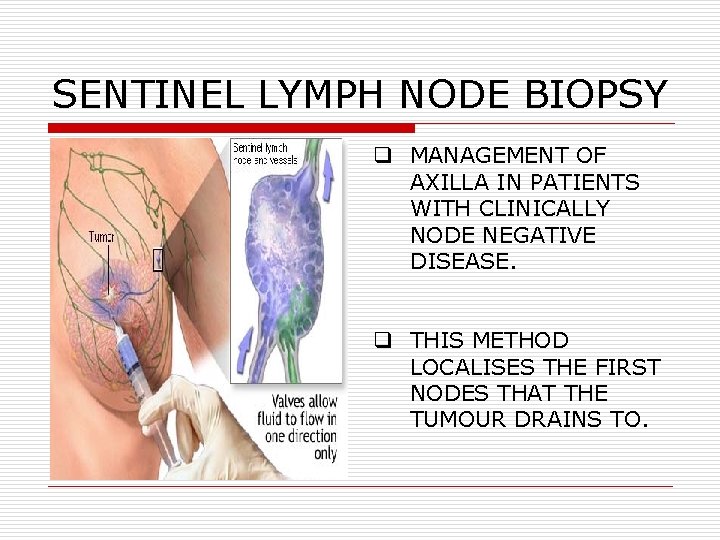 SENTINEL LYMPH NODE BIOPSY q MANAGEMENT OF AXILLA IN PATIENTS WITH CLINICALLY NODE NEGATIVE SENTINEL LYMPH NODE BIOPSY q MANAGEMENT OF AXILLA IN PATIENTS WITH CLINICALLY NODE NEGATIVE