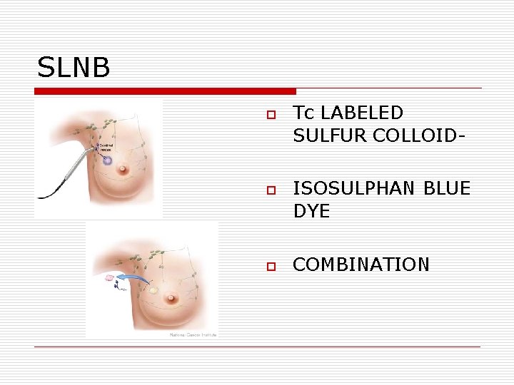 SLNB o o o Tc LABELED SULFUR COLLOIDISOSULPHAN BLUE DYE COMBINATION SLNB o o o Tc LABELED SULFUR COLLOIDISOSULPHAN BLUE DYE COMBINATION