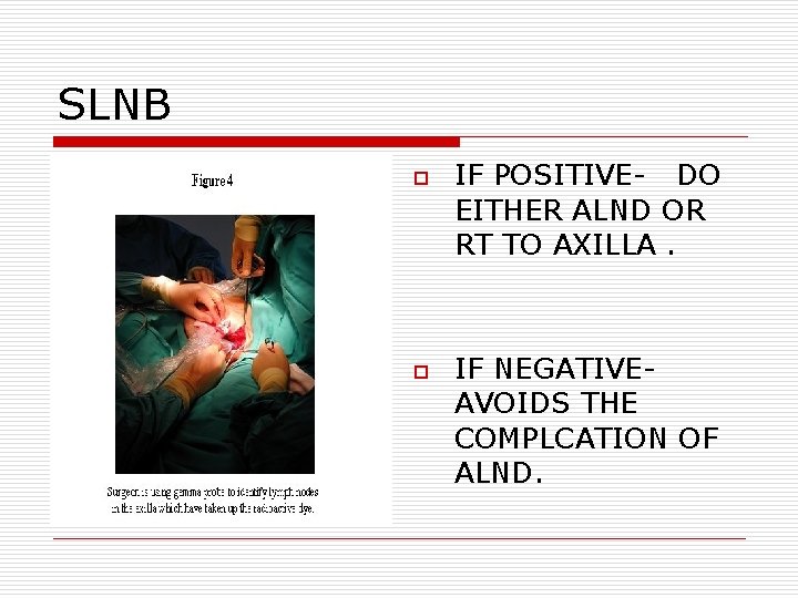 SLNB o o IF POSITIVE- DO EITHER ALND OR RT TO AXILLA. IF NEGATIVEAVOIDS SLNB o o IF POSITIVE- DO EITHER ALND OR RT TO AXILLA. IF NEGATIVEAVOIDS