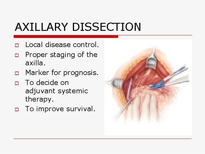AXILLARY DISSECTION o o o Local disease control. Proper staging of the axilla. Marker AXILLARY DISSECTION o o o Local disease control. Proper staging of the axilla. Marker