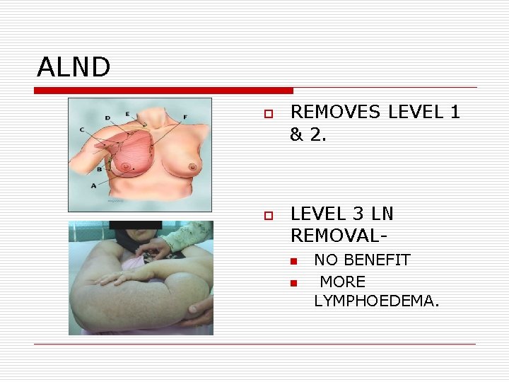 ALND o o REMOVES LEVEL 1 & 2. LEVEL 3 LN REMOVALn n NO ALND o o REMOVES LEVEL 1 & 2. LEVEL 3 LN REMOVALn n NO