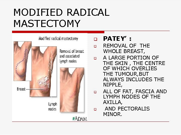 MODIFIED RADICAL MASTECTOMY q q q PATEY’ : REMOVAL OF THE WHOLE BREAST, A MODIFIED RADICAL MASTECTOMY q q q PATEY’ : REMOVAL OF THE WHOLE BREAST, A