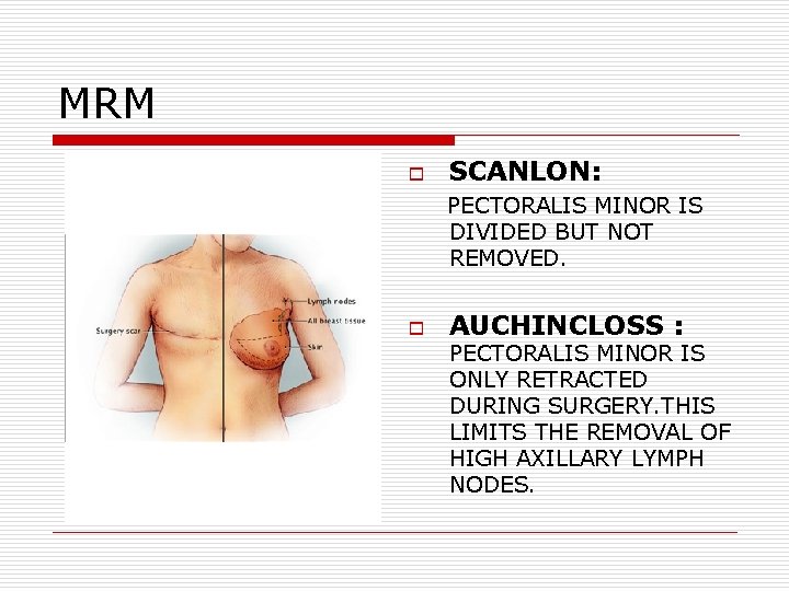 MRM o SCANLON: PECTORALIS MINOR IS DIVIDED BUT NOT REMOVED. o AUCHINCLOSS : PECTORALIS MRM o SCANLON: PECTORALIS MINOR IS DIVIDED BUT NOT REMOVED. o AUCHINCLOSS : PECTORALIS