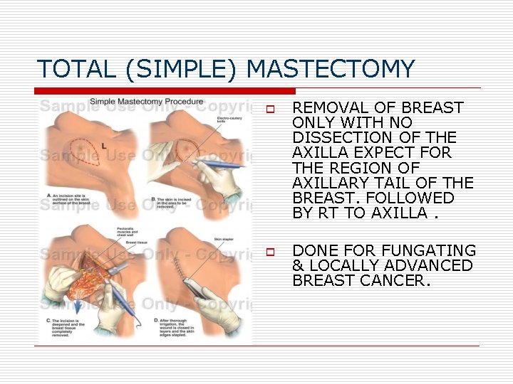 TOTAL (SIMPLE) MASTECTOMY o o REMOVAL OF BREAST ONLY WITH NO DISSECTION OF THE TOTAL (SIMPLE) MASTECTOMY o o REMOVAL OF BREAST ONLY WITH NO DISSECTION OF THE