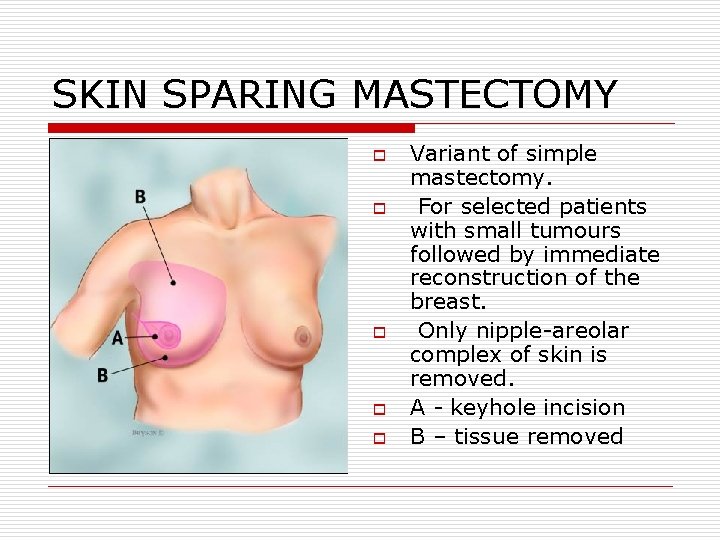 SKIN SPARING MASTECTOMY o o o Variant of simple mastectomy. For selected patients with SKIN SPARING MASTECTOMY o o o Variant of simple mastectomy. For selected patients with