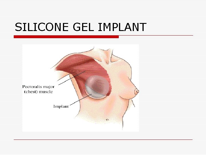 SILICONE GEL IMPLANT SILICONE GEL IMPLANT
