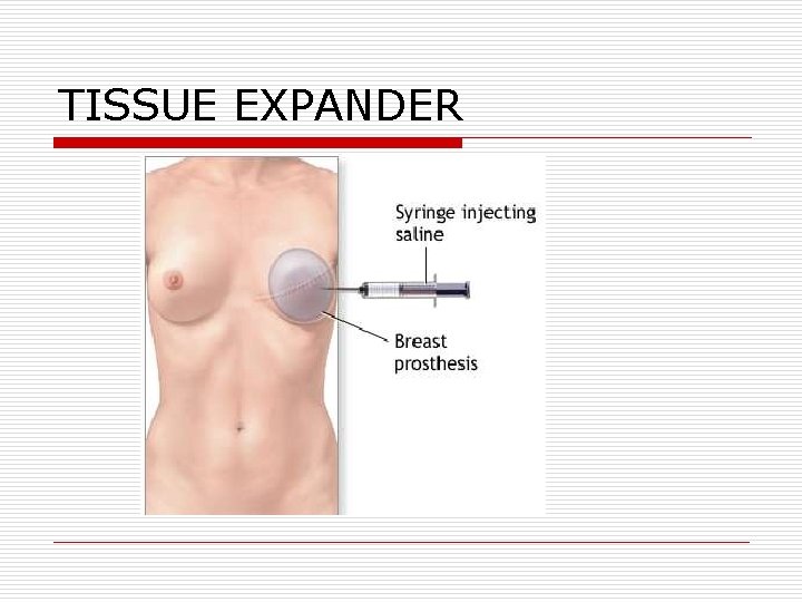 TISSUE EXPANDER TISSUE EXPANDER