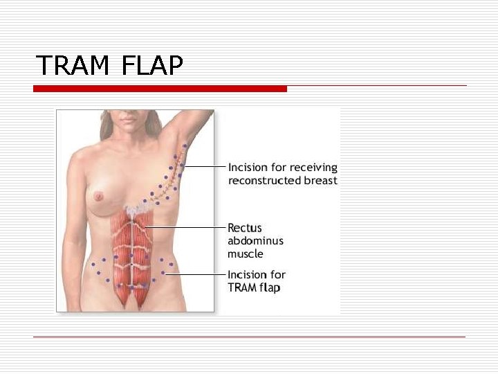 TRAM FLAP TRAM FLAP
