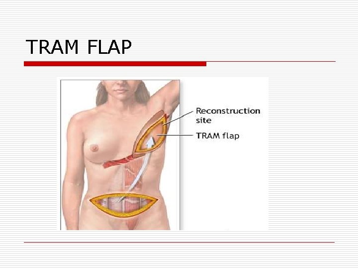 TRAM FLAP TRAM FLAP