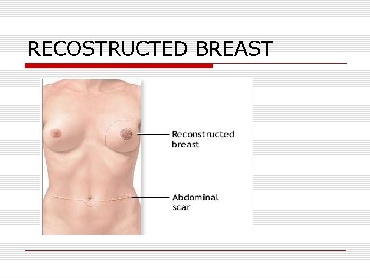 RECOSTRUCTED BREAST RECOSTRUCTED BREAST