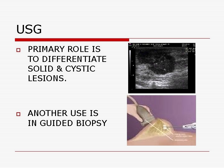 USG o o PRIMARY ROLE IS TO DIFFERENTIATE SOLID & CYSTIC LESIONS. ANOTHER USE USG o o PRIMARY ROLE IS TO DIFFERENTIATE SOLID & CYSTIC LESIONS. ANOTHER USE