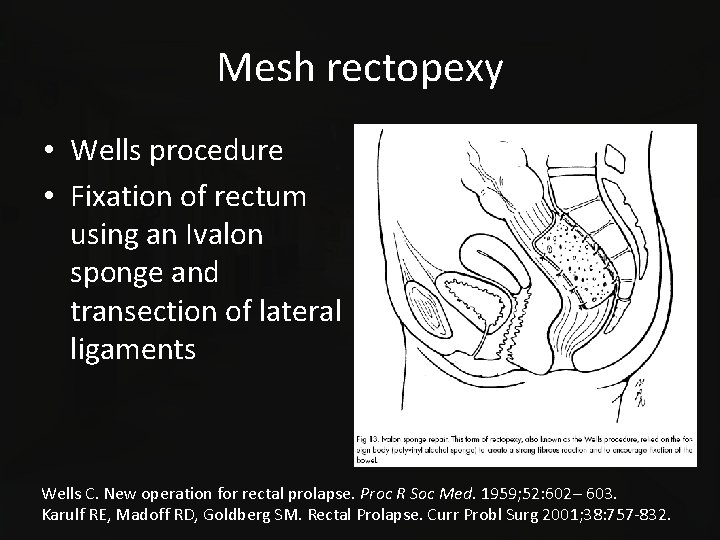 Mesh rectopexy • Wells procedure • Fixation of rectum using an Ivalon sponge and
