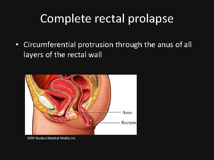 Complete rectal prolapse • Circumferential protrusion through the anus of all layers of the