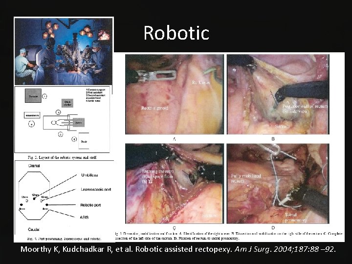 Robotic Moorthy K, Kudchadkar R, et al. Robotic assisted rectopexy. Am J Surg. 2004;