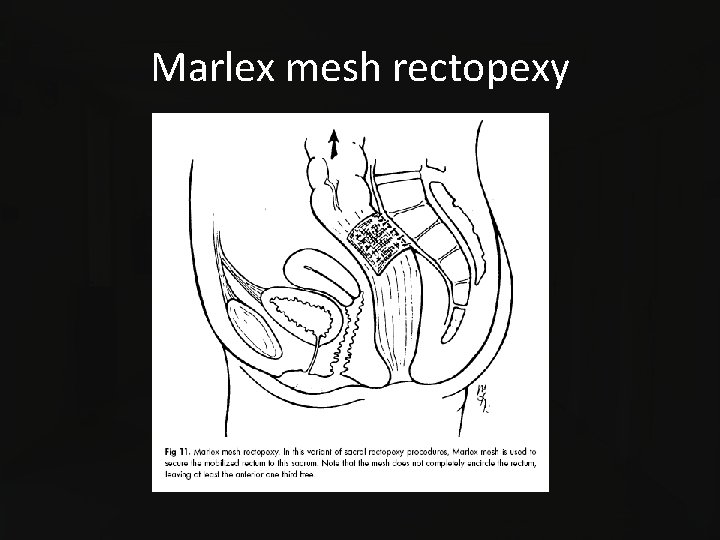 Marlex mesh rectopexy 