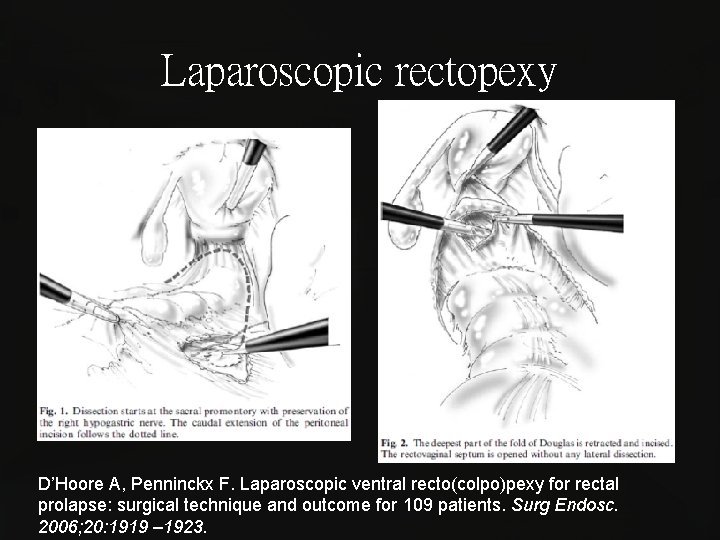 Laparoscopic rectopexy D’Hoore A, Penninckx F. Laparoscopic ventral recto(colpo)pexy for rectal prolapse: surgical technique