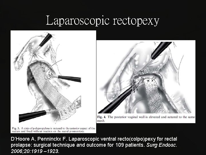 Laparoscopic rectopexy D’Hoore A, Penninckx F. Laparoscopic ventral recto(colpo)pexy for rectal prolapse: surgical technique