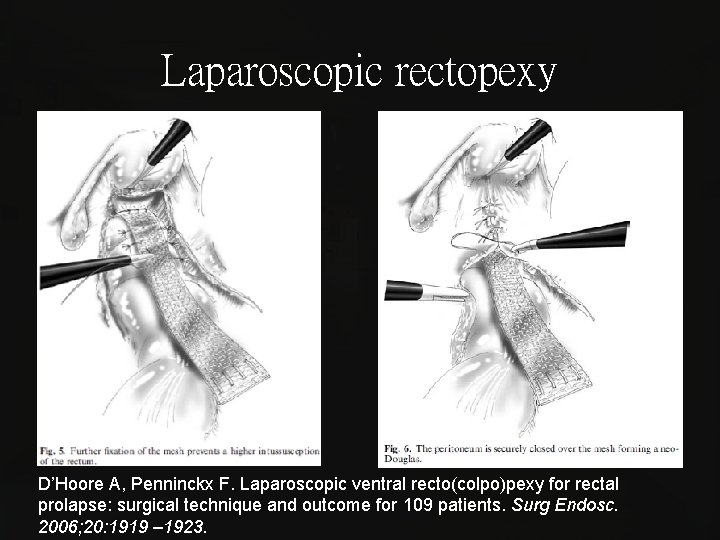 Laparoscopic rectopexy D’Hoore A, Penninckx F. Laparoscopic ventral recto(colpo)pexy for rectal prolapse: surgical technique