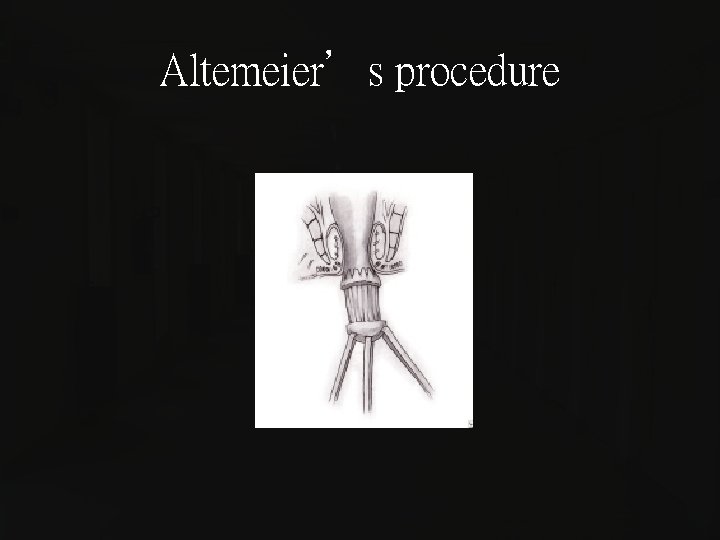 Altemeier’s procedure 